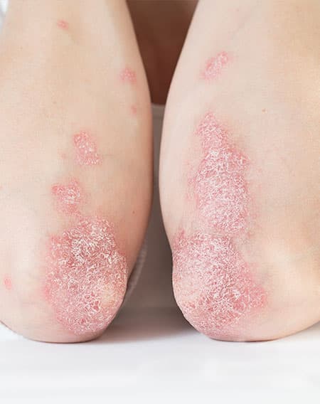 dermatology, acne treatment, skin cancer